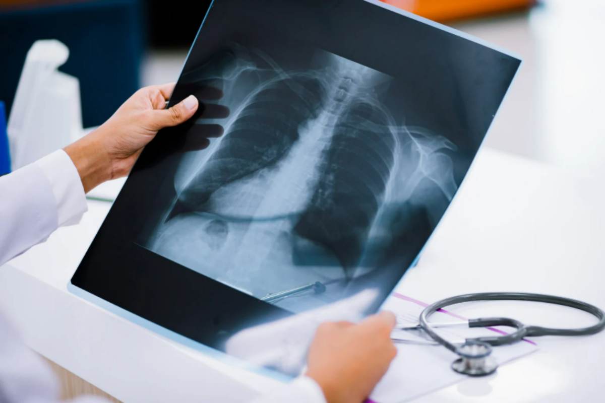 radiografia polmoni